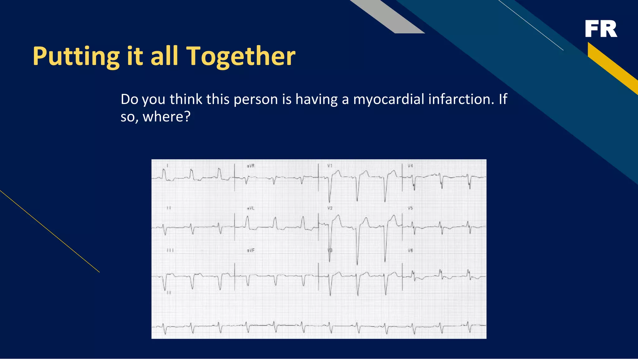 FR
Putting it all Together
Do you think this person is having a myocardial infarction. If
so, where?
 
