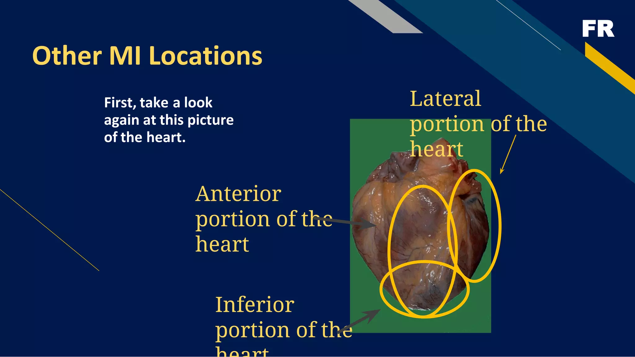 FR
Other MI Locations
First, take a look
again at this picture
of the heart.
Anterior
portion of the
heart
Lateral
portion of the
heart
Inferior
portion of the
 