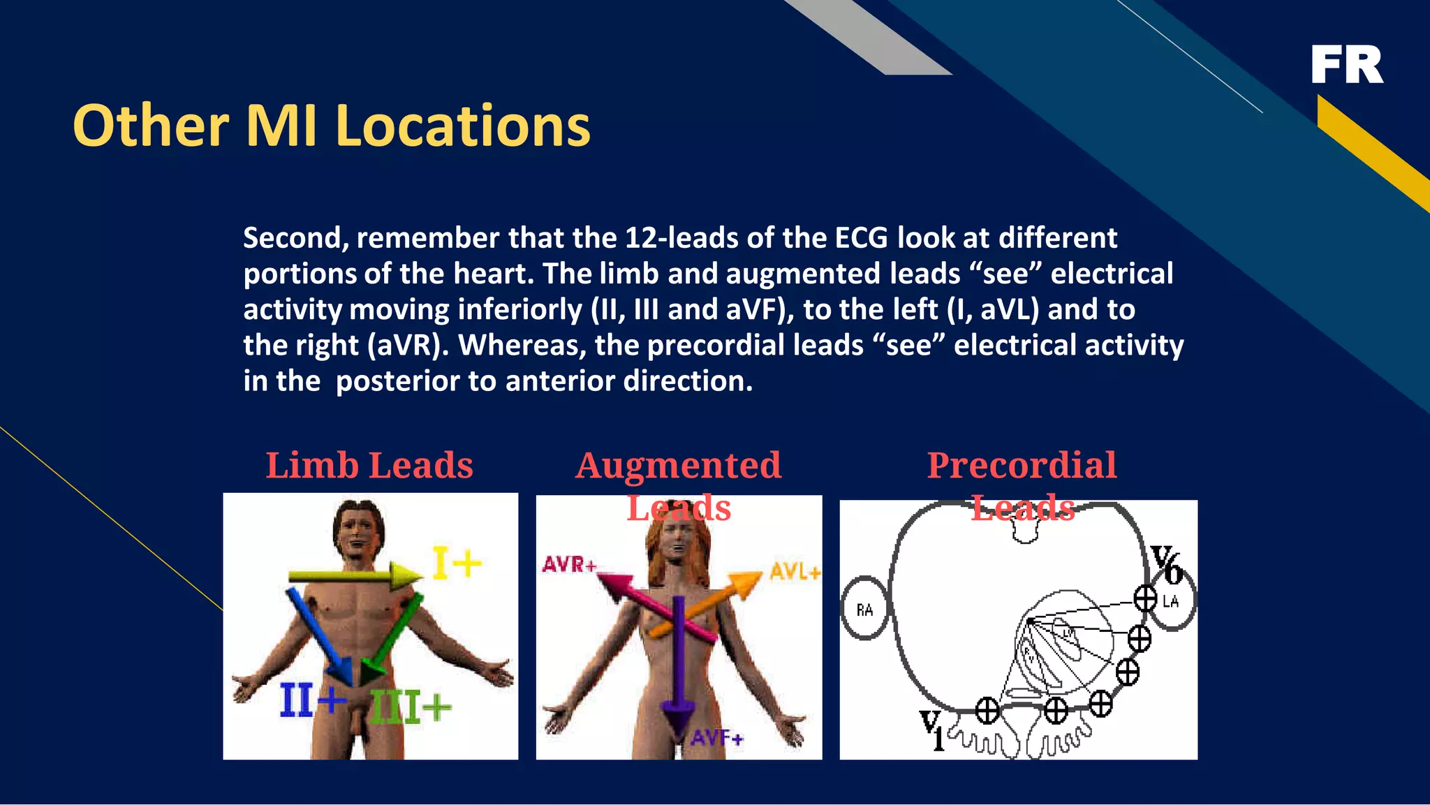 FR
Other MI Locations
Second, remember that the 12-leads of the ECG look at different
portions of the heart. The limb and augmented leads “see” electrical
activity moving inferiorly (II, III and aVF), to the left (I, aVL) and to
the right (aVR). Whereas, the precordial leads “see” electrical activity
in the posterior to anterior direction.
Limb Leads Augmented
Leads
Precordial
Leads
 