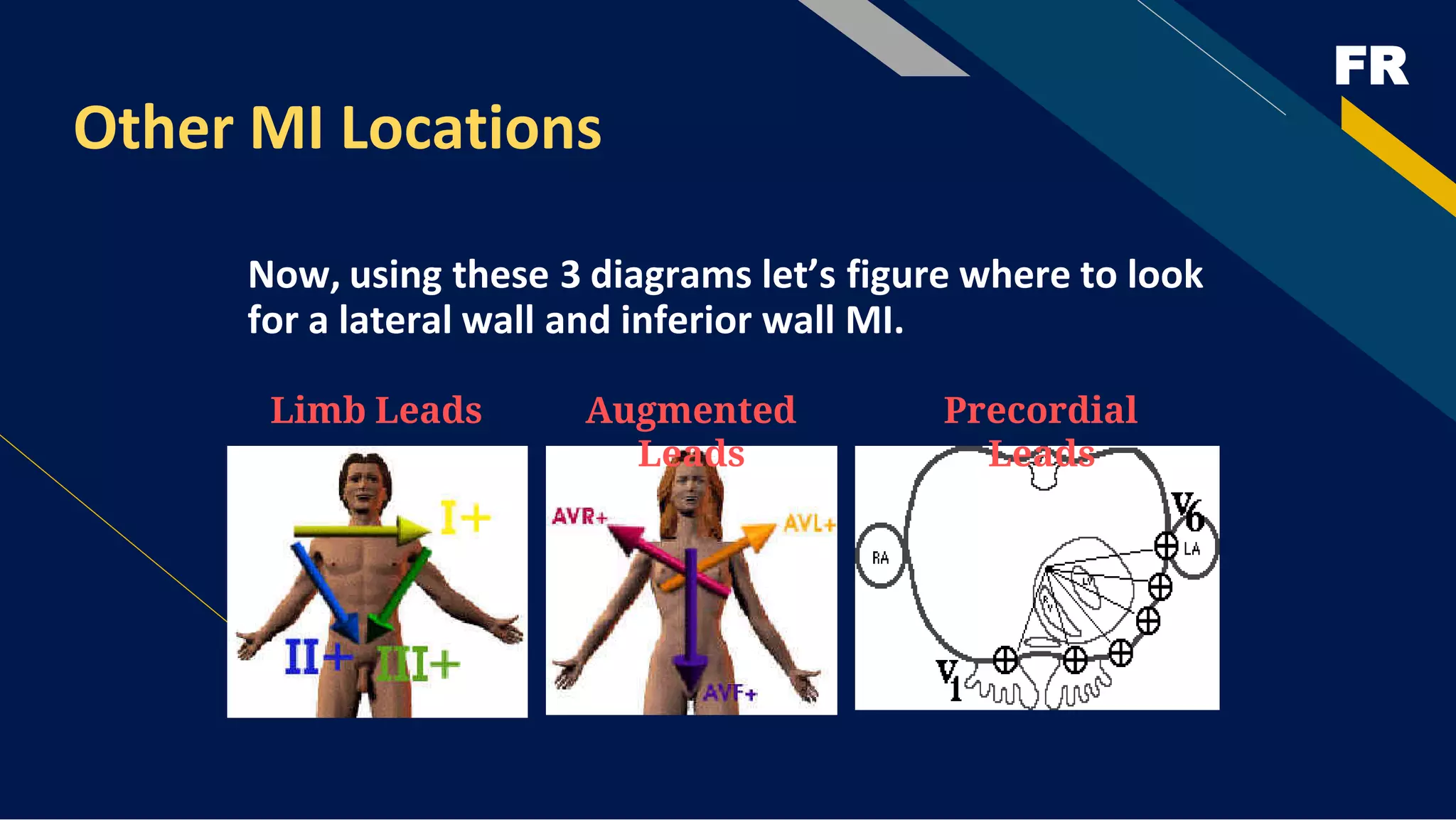 FR
Other MI Locations
Now, using these 3 diagrams let’s figure where to look
for a lateral wall and inferior wall MI.
Limb Leads Augmented
Leads
Precordial
Leads
 