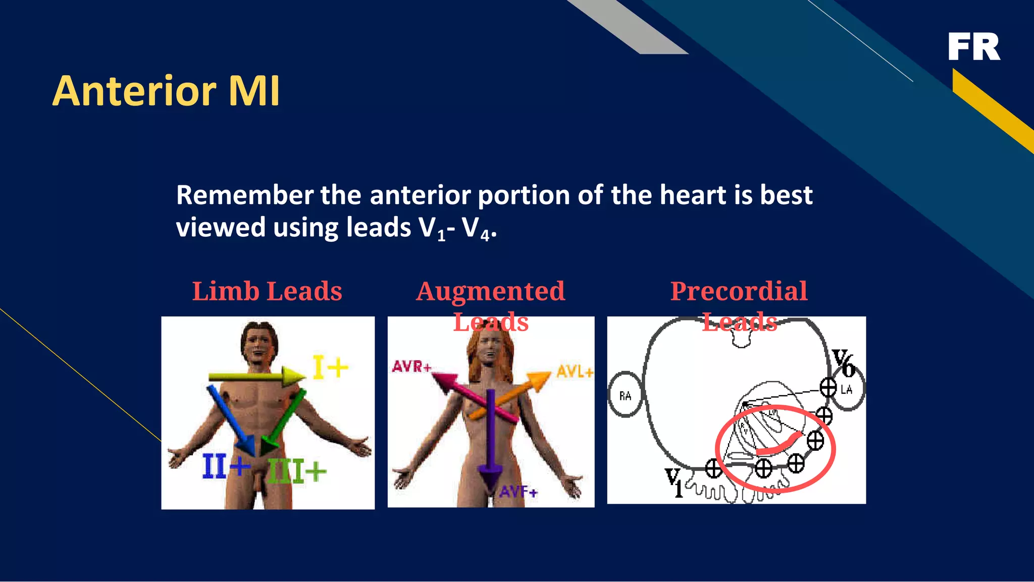 FR
Anterior MI
Remember the anterior portion of the heart is best
viewed using leads V1- V4.
Limb Leads Augmented
Leads
Precordial
Leads
 