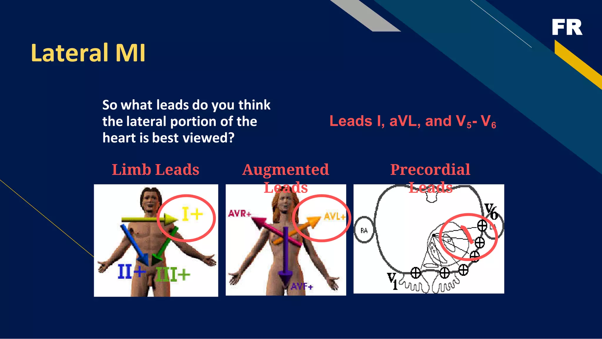 FR
Lateral MI
So what leads do you think
the lateral portion of the
heart is best viewed?
Limb Leads Augmented
Leads
Precordial
Leads
Leads I, aVL, and V5- V6
 