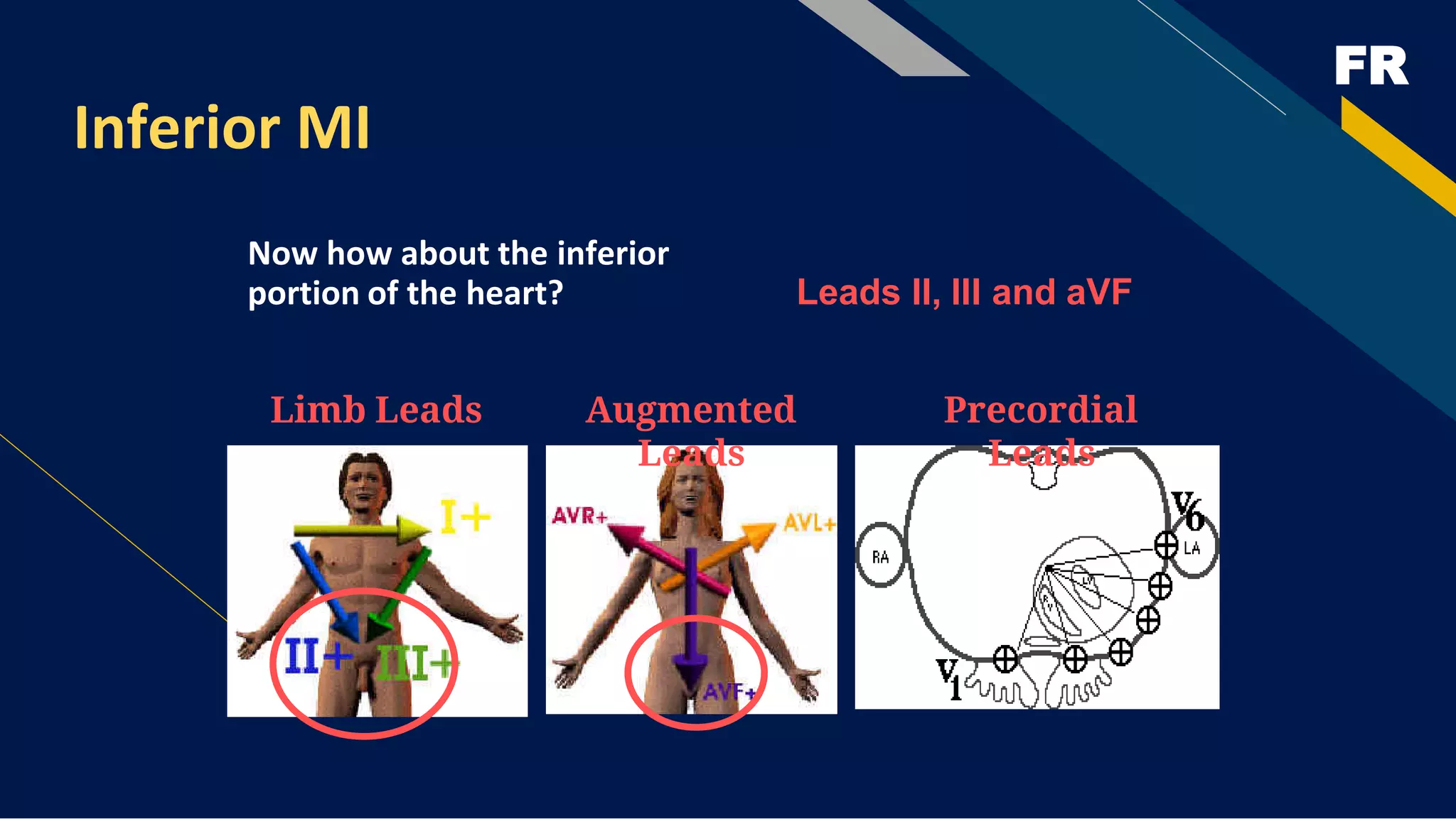 FR
Inferior MI
Now how about the inferior
portion of the heart?
Limb Leads Augmented
Leads
Precordial
Leads
Leads II, III and aVF
 