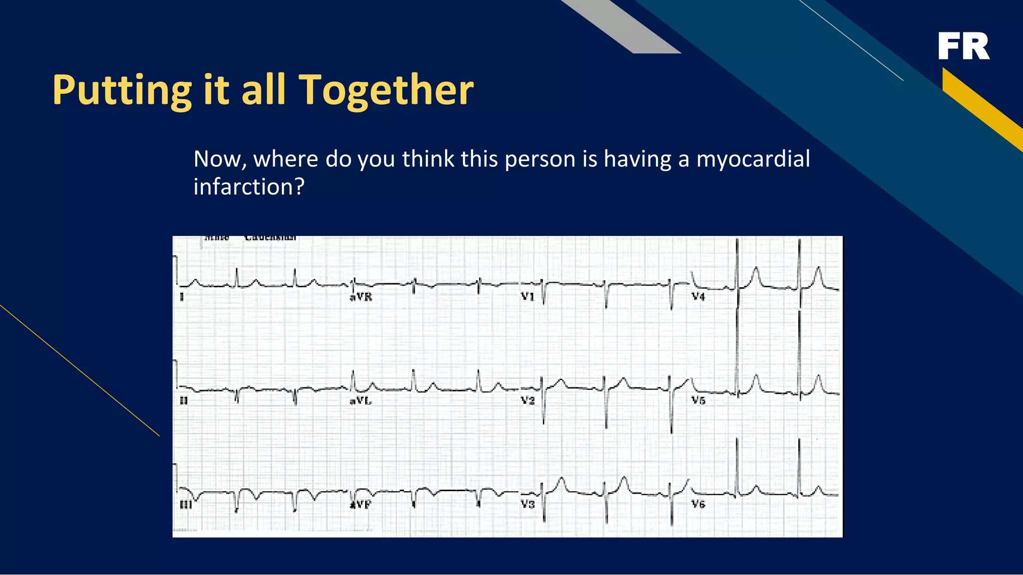 FR
Putting it all Together
Now, where do you think this person is having a myocardial
infarction?
 