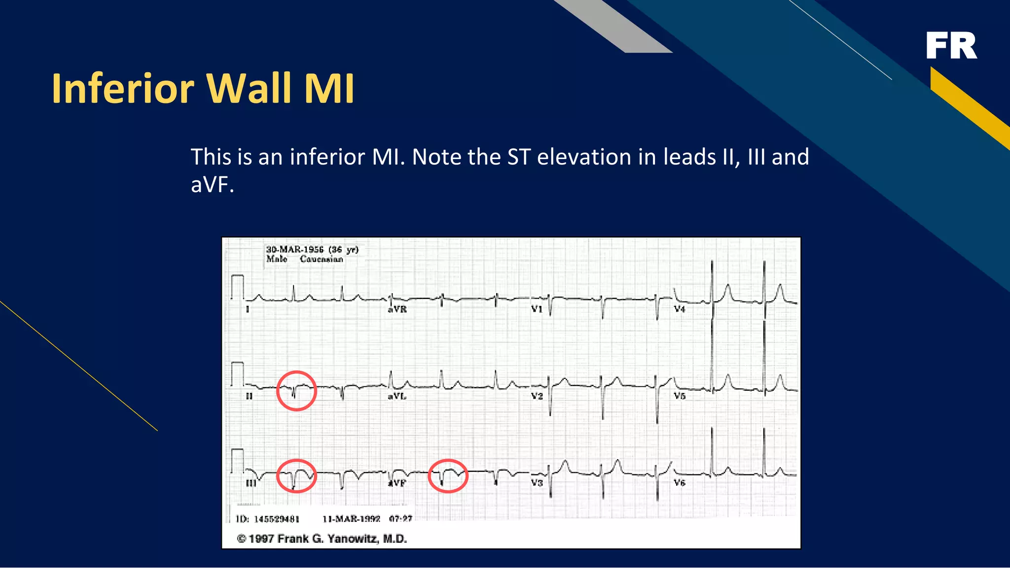 FR
Inferior Wall MI
This is an inferior MI. Note the ST elevation in leads II, III and
aVF.
 