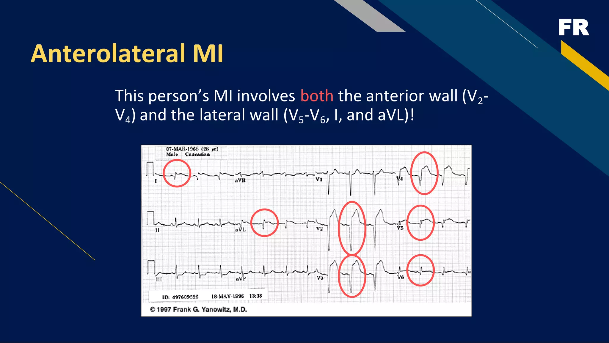 FR
Anterolateral MI
This person’s MI involves both the anterior wall (V2-
V4) and the lateral wall (V5-V6, I, and aVL)!
 