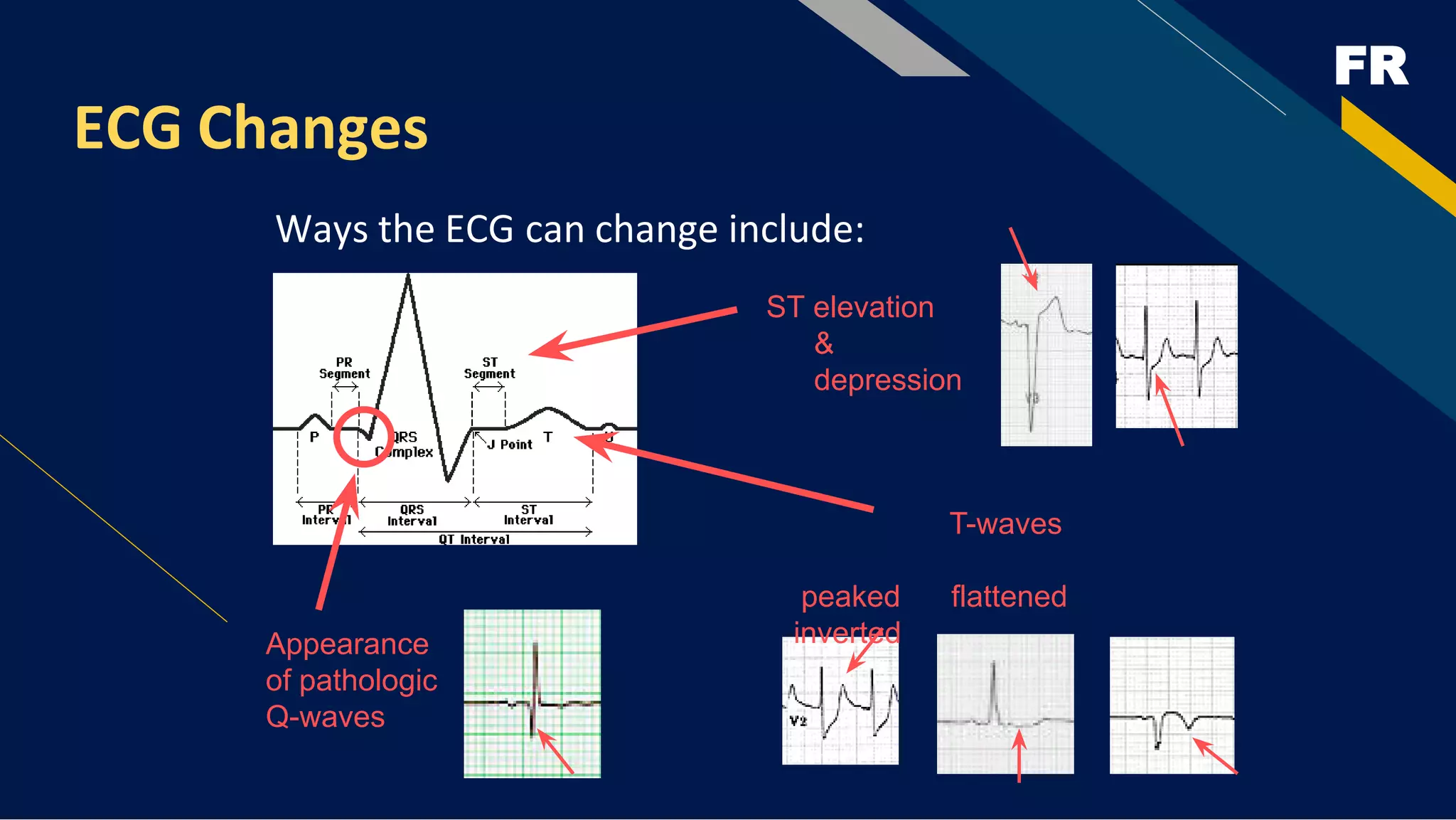 FR
ECG Changes
Ways the ECG can change include:
Appearance
of pathologic
Q-waves
T-waves
peaked flattened
inverted
ST elevation
&
depression
 
