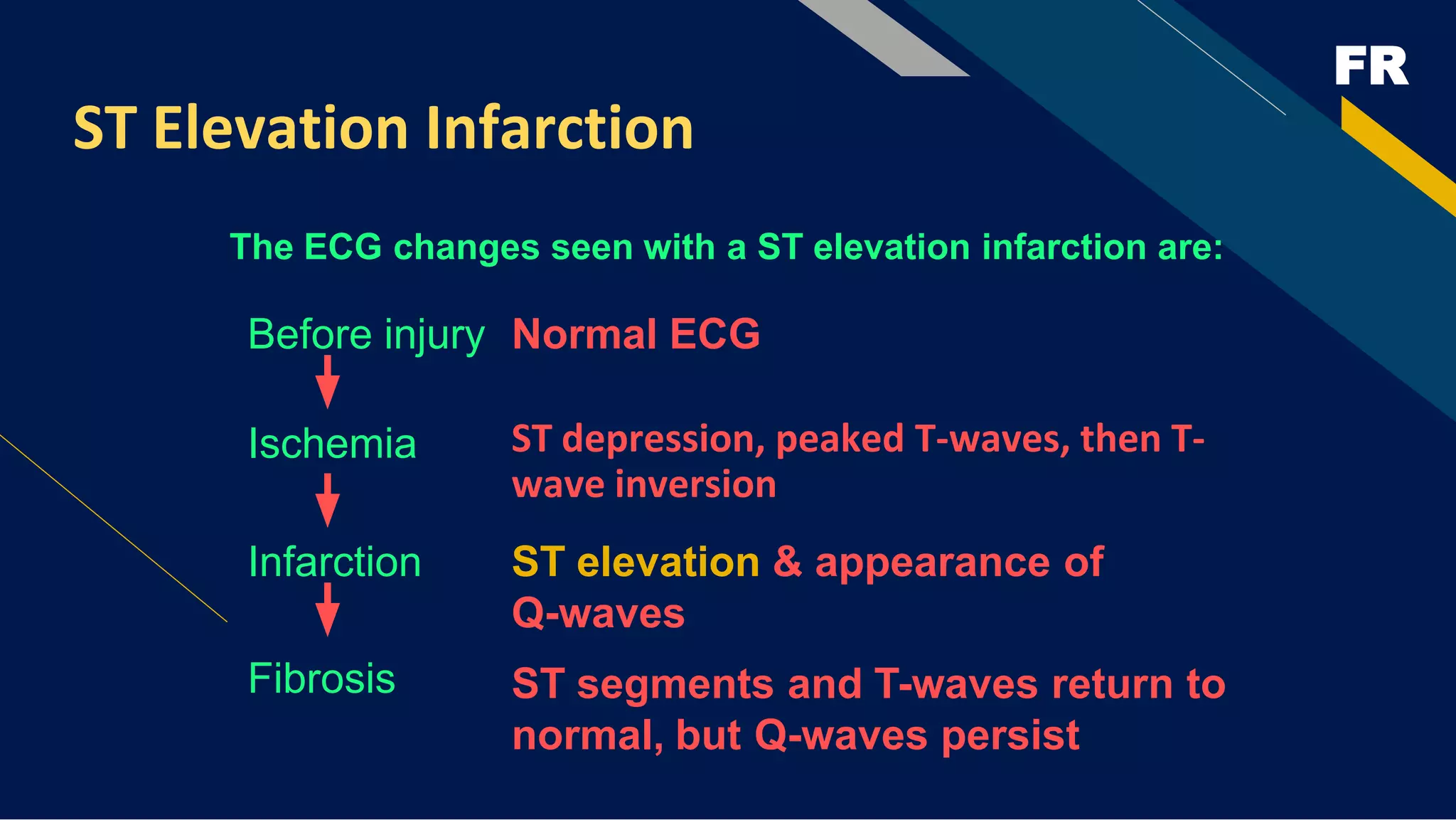 FR
ST Elevation Infarction
ST depression, peaked T-waves, then T-
wave inversion
The ECG changes seen with a ST elevation infarction are:
Before injury Normal ECG
ST elevation & appearance of
Q-waves
ST segments and T-waves return to
normal, but Q-waves persist
Ischemia
Infarction
Fibrosis
 