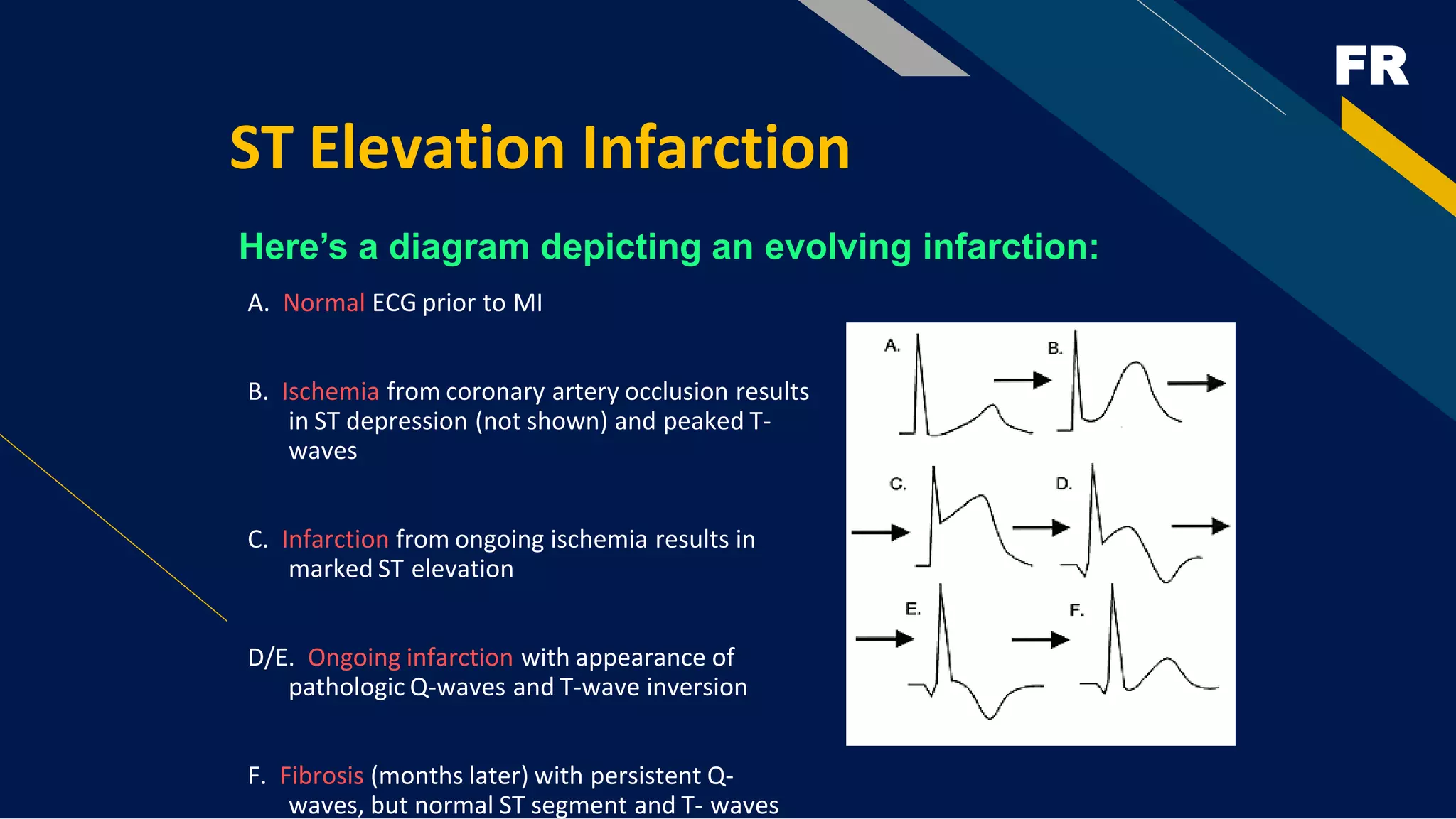 FR
ST Elevation Infarction
Here’s a diagram depicting an evolving infarction:
A. Normal ECG prior to MI
B. Ischemia from coronary artery occlusion results
in ST depression (not shown) and peaked T-
waves
C. Infarction from ongoing ischemia results in
marked ST elevation
D/E. Ongoing infarction with appearance of
pathologic Q-waves and T-wave inversion
F. Fibrosis (months later) with persistent Q-
waves, but normal ST segment and T- waves
 