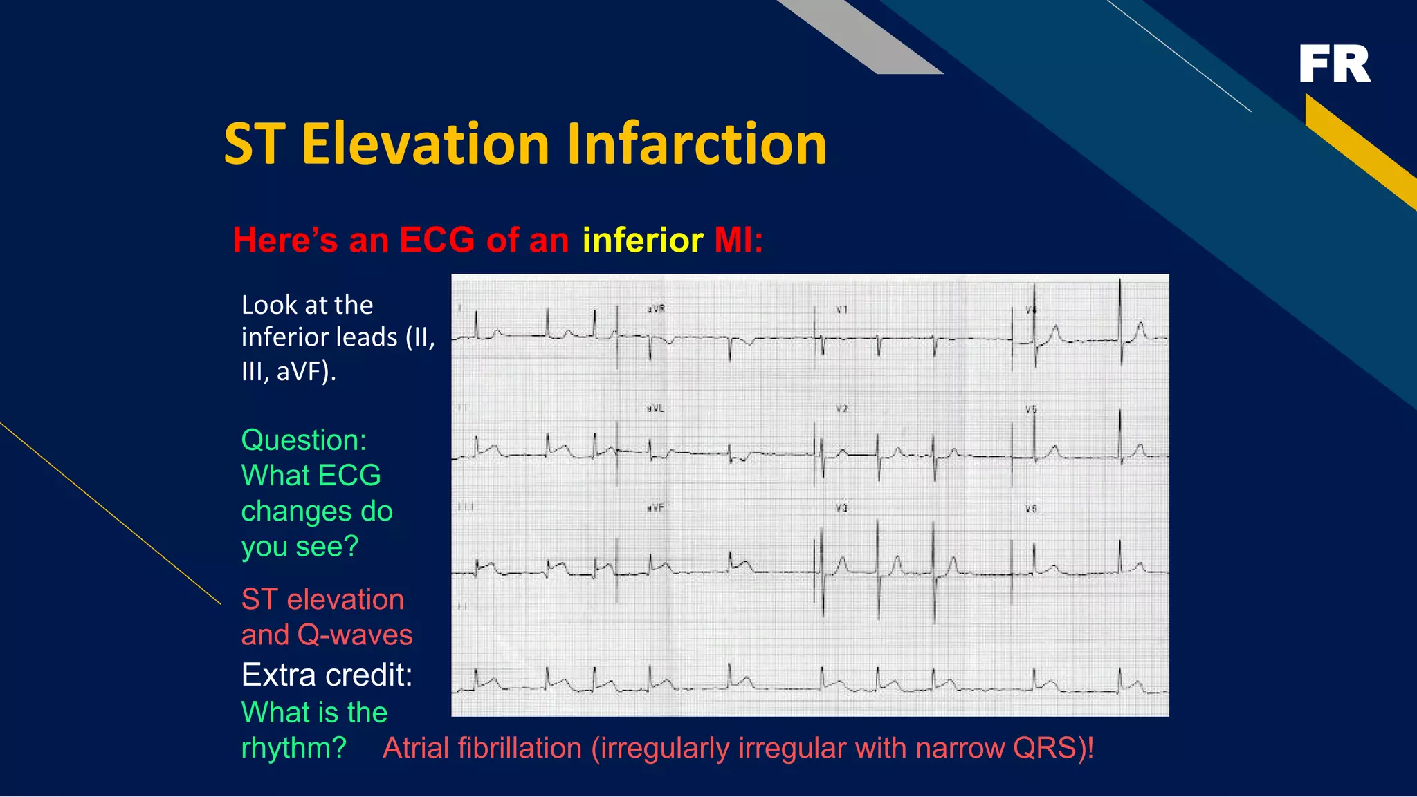 FR
ST Elevation Infarction
Here’s an ECG of an inferior MI:
Look at the
inferior leads (II,
III, aVF).
Question:
What ECG
changes do
you see?
ST elevation
and Q-waves
Extra credit:
What is the
rhythm? Atrial fibrillation (irregularly irregular with narrow QRS)!
 
