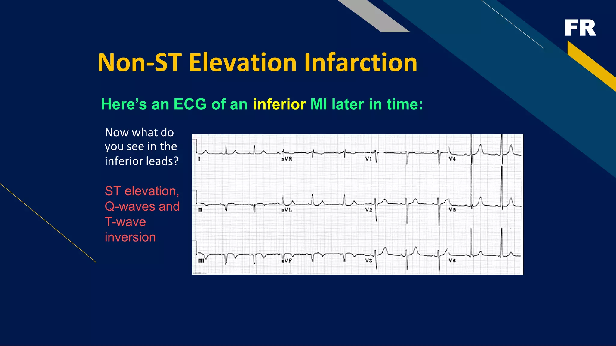 FR
Non-ST Elevation Infarction
Here’s an ECG of an inferior MI later in time:
Now what do
you see in the
inferior leads?
ST elevation,
Q-waves and
T-wave
inversion
 