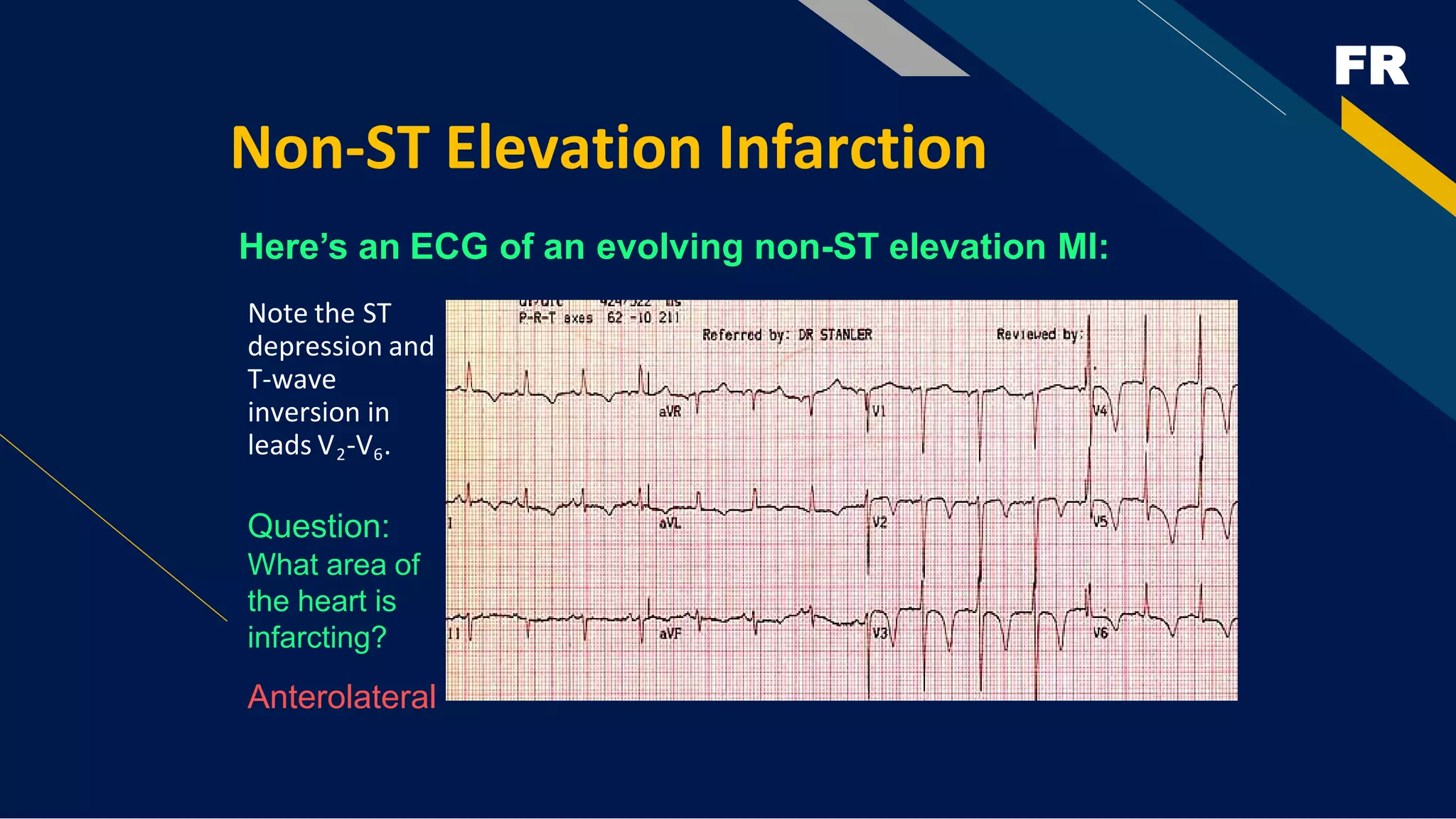 FR
Non-ST Elevation Infarction
Here’s an ECG of an evolving non-ST elevation MI:
Note the ST
depression and
T-wave
inversion in
leads V2-V6.
Question:
What area of
the heart is
infarcting?
Anterolateral
 