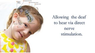 Allowing the deaf
to hear via direct
nerve
stimulation.
 