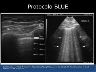 blue protocol Bedside lung Ultrasound in emergency | PPTX