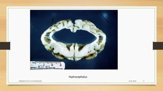 24-09-2020ABHIJITH SP CVAS POOKODE 17
Hydrocephalus
 