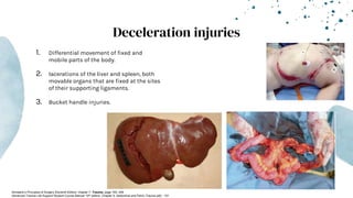 Deceleration injuries
1. Differential movement of fixed and
mobile parts of the body.
2. lacerations of the liver and spleen, both
movable organs that are fixed at the sites
of their supporting ligaments.
3. Bucket handle injuries.
-Schwartz’s Principles of Surgery Eleventh Edition: chapter 7- Trauma, page 183- 249
-Advanced Trauma Life Support Student Course Manual 10th edition. Chapter 5, Abdominal and Pelvic Trauma p82 - 101
 