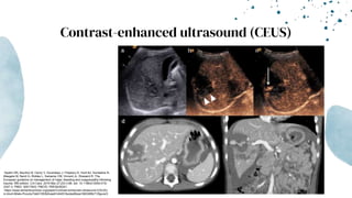 Contrast-enhanced ultrasound (CEUS)
-Spahn DR, Bouillon B, Cerny V, Duranteau J, Filipescu D, Hunt BJ, Komadina R,
Maegele M, Nardi G, Riddez L, Samama CM, Vincent JL, Rossaint R. The
European guideline on management of major bleeding and coagulopathy following
trauma: fifth edition. Crit Care. 2019 Mar 27;23(1):98. doi: 10.1186/s13054-019-
2347-3. PMID: 30917843; PMCID: PMC6436241.
-https://www.semanticscholar.org/paper/Contrast-enhanced-ultrasound-(CEUS)-
in-blunt-Miele-Piccolo/7eb01553b5cae61d4451facdad5bea1900385b71/figure/3
 