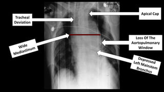 EMGuideWire's Radiology Reading Room: Blunt Aortic Injury | PPTX