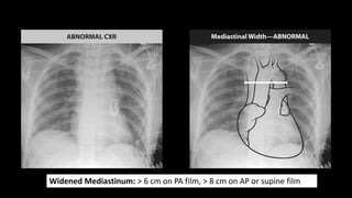 TAD Chest X-Ray Findings
1. Wide mediastinum
2. Abnormal aortic contour
3. Loss of aortopulmonary window
4. Tracheal devia...
