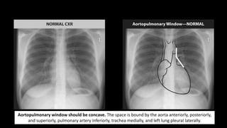 Aortopulmonary window should be concave. The space is bound by the aorta anteriorly, posteriorly,
and superiorly, pulmonary artery inferiorly, trachea medially, and left lung pleural laterally.
 