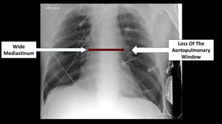 33-year-old Male On A
Moped Struck By A Car
Wide
Mediastinum
Traumatic Aortic Disruption
 