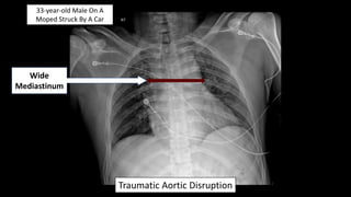 33-year-old Male On A
Moped Struck By A Car
Wide
Mediastinum
Traumatic Aortic Disruption
 
