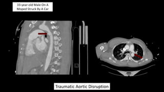Young Adult In A Motor Vehicle Crash
Thoracic Endovascular Aortic Repair [TEVAR]
Coarctation Of The Thoracic Aorta
 