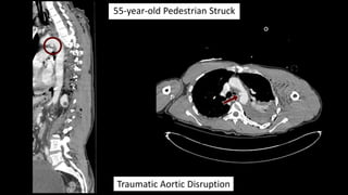 Pedestrian
Struck By An
SUV
Traumatic Aortic Disruption [TAD]
 Typically a high mechanism of injury.
 MVC, pedestrian st...