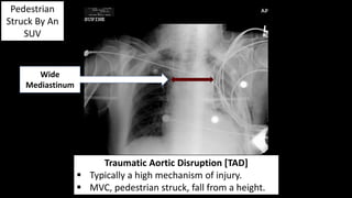 Pedestrian
Struck By An
SUV
Traumatic Aortic Disruption [TAD]
 Typically a high mechanism of injury.
 MVC, pedestrian struck, fall from a height.
Wide
Mediastinum
 