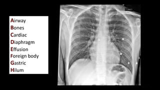 Airway
Bones
Cardiac
Diaphragm
Effusion
Foreign body
Gastric
Hilum
 