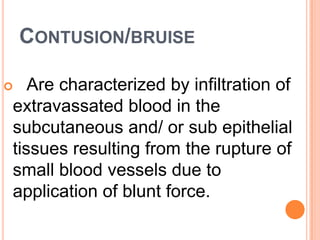 Contusion/bruiseAre characterized by infiltration of extravassated blood in the subcutaneous and/ or sub epithelial tissues resulting from the rupture of small blood vessels due to application of blunt force. 