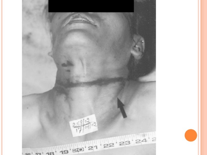 Blunt force injuries