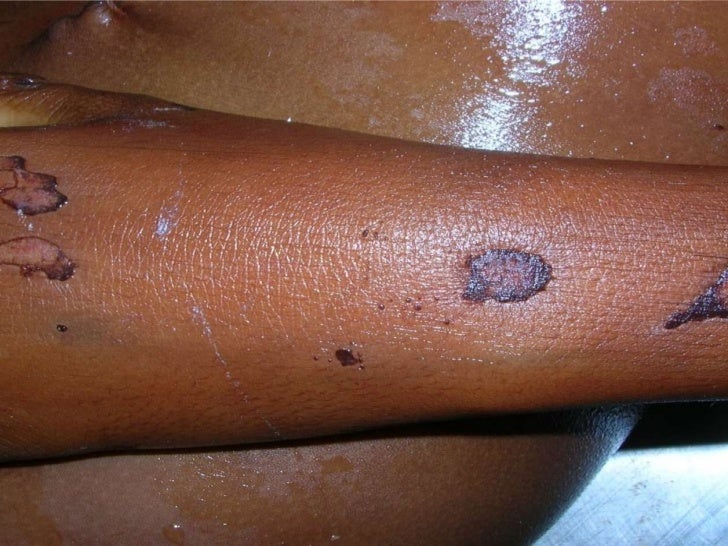 Blunt force injuries