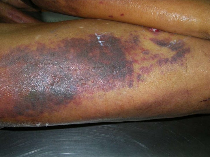 blunt force trauma