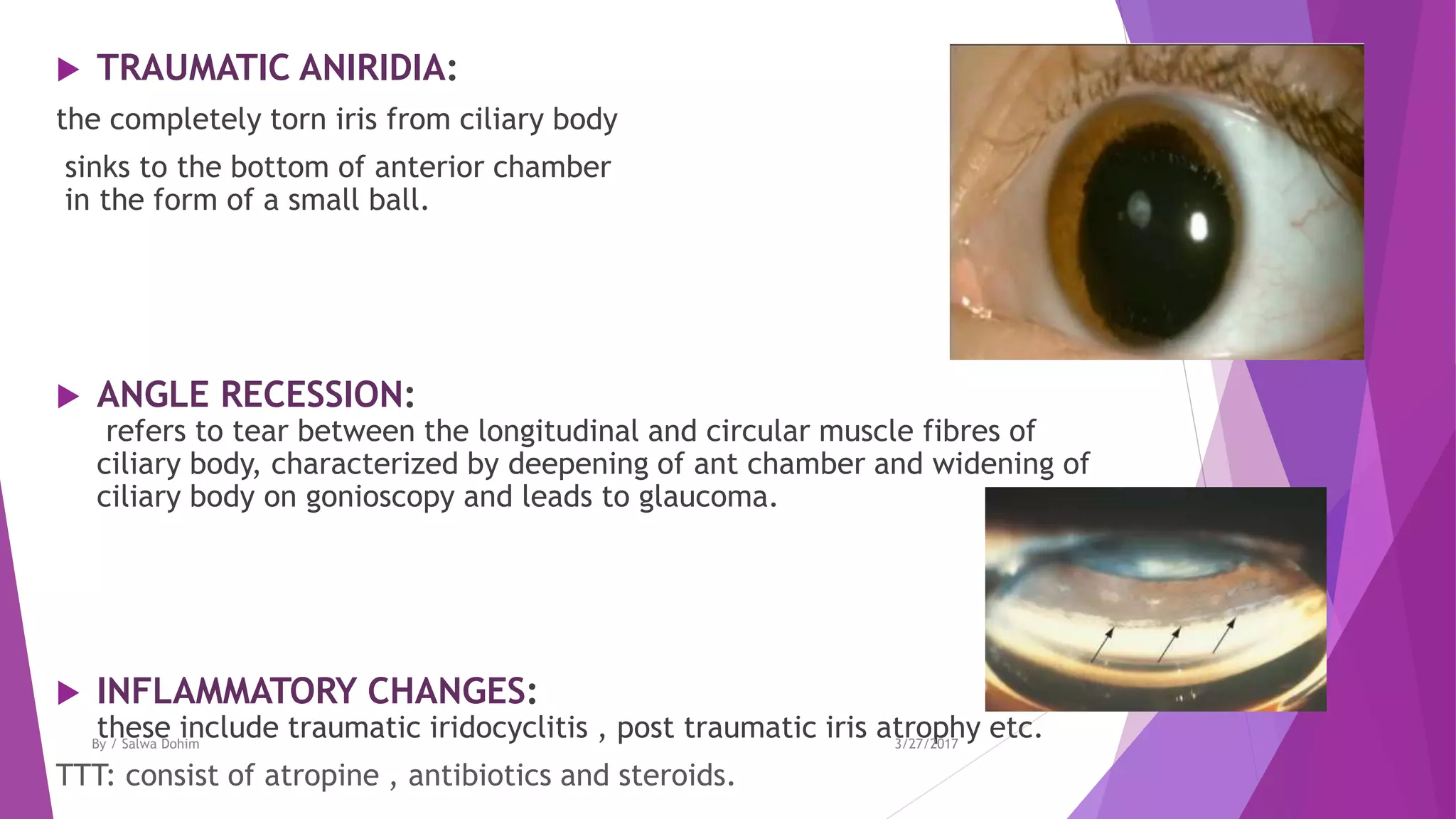  TRAUMATIC ANIRIDIA:
the completely torn iris from ciliary body
sinks to the bottom of anterior chamber
in the form of a small ball.
 ANGLE RECESSION:
refers to tear between the longitudinal and circular muscle fibres of
ciliary body, characterized by deepening of ant chamber and widening of
ciliary body on gonioscopy and leads to glaucoma.
 INFLAMMATORY CHANGES:
these include traumatic iridocyclitis , post traumatic iris atrophy etc.
TTT: consist of atropine , antibiotics and steroids.
3/27/2017By / Salwa Dohim
 