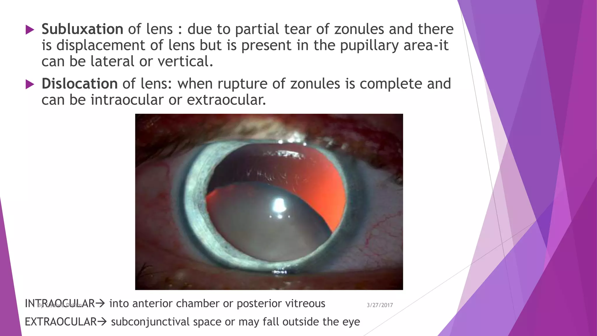  Subluxation of lens : due to partial tear of zonules and there
is displacement of lens but is present in the pupillary area-it
can be lateral or vertical.
 Dislocation of lens: when rupture of zonules is complete and
can be intraocular or extraocular.
INTRAOCULAR into anterior chamber or posterior vitreous
EXTRAOCULAR subconjunctival space or may fall outside the eye
3/27/2017By / Salwa Dohim
 