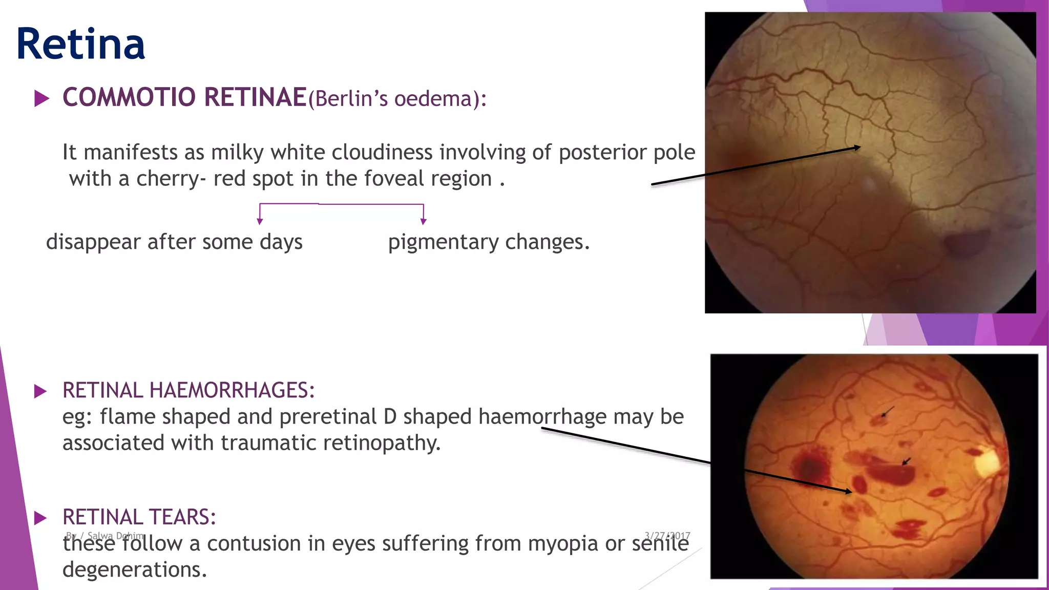 Retina
 COMMOTIO RETINAE(Berlin’s oedema):
It manifests as milky white cloudiness involving of posterior pole
with a cherry- red spot in the foveal region .
disappear after some days pigmentary changes.
 RETINAL HAEMORRHAGES:
eg: flame shaped and preretinal D shaped haemorrhage may be
associated with traumatic retinopathy.
 RETINAL TEARS:
these follow a contusion in eyes suffering from myopia or senile
degenerations.
3/27/2017By / Salwa Dohim
 