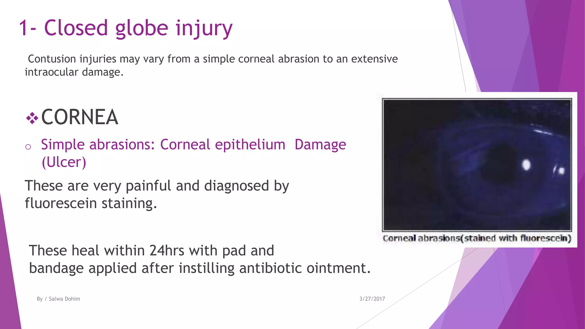 1- Closed globe injury
Contusion injuries may vary from a simple corneal abrasion to an extensive
intraocular damage.
CORNEA
o Simple abrasions: Corneal epithelium Damage
(Ulcer)
These are very painful and diagnosed by
fluorescein staining.
These heal within 24hrs with pad and
bandage applied after instilling antibiotic ointment.
3/27/2017By / Salwa Dohim
 