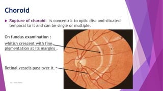 Blunt trauma of the eye | PPTX