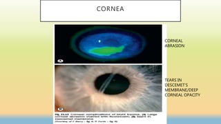 CORNEA
CORNEAL
ABRASION
TEARS IN
DESCEMET’S
MEMBRANE/DEEP
CORNEAL OPACITY
 