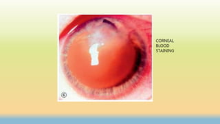 CORNEAL
BLOOD
STAINING
 