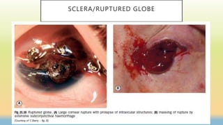 SCLERA/RUPTURED GLOBE
 