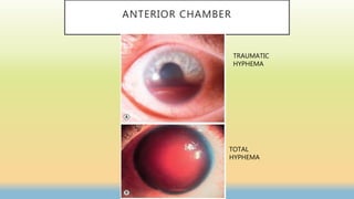 ANTERIOR CHAMBER
TRAUMATIC
HYPHEMA
TOTAL
HYPHEMA
 
