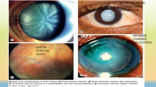 FLOWER
SHAPED
CATARACT
DENSE TRAUMATIC
CATARACT WITH
SUBLUXATION
LENS IN
VITREOUS
CAVITY
ANTERIOR
CHAMBER
DISLOCATION
 