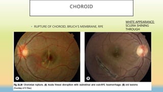 CHOROID
• RUPTURE OF CHOROID, BRUCH’S MEMBRANE, RPE
WHITE APPEARANCE:
SCLERA SHINING
THROUGH
 