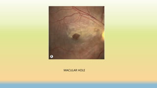 MACULAR HOLE
 