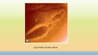 EQUATORIAL RETINAL BREAK
 