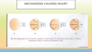 MECHANISMS CAUSING INJURY
 