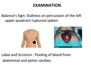 EXAMINATION
Balance’s Sign: Dullness on percussion of the left
upper quadrant ruptured spleen
Labia and Scrotum : Pooling of blood from
abdominal and pelvic cavities.
 