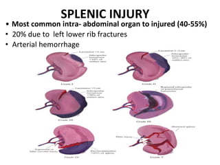 SPLENIC INJURY
• Most common intra- abdominal organ to injured (40-55%)
• 20% due to left lower rib fractures
• Arterial hemorrhage
 